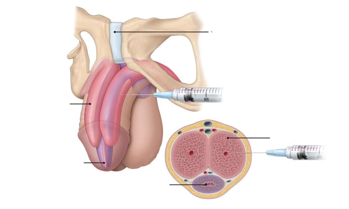 injection pour une puissance accrue